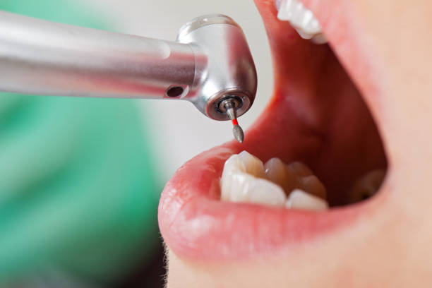 Best Emergency Dentist for Lost Fillings or Crowns in Alpine, CA